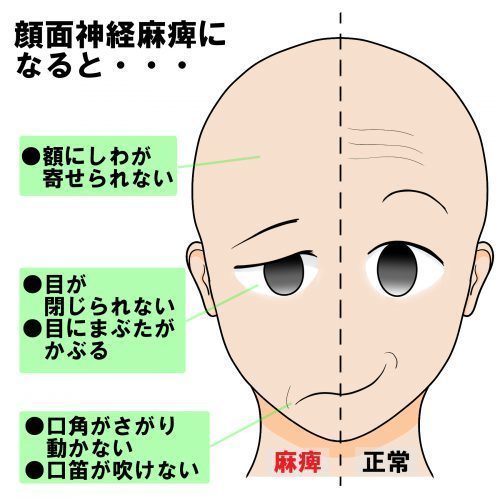 麻痺 ベル ベル麻痺の症状,原因と治療の病院を探す