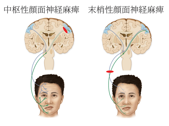 顔面神経麻痺の治療なら上田端はり灸整骨院 田端 鍼灸院なら上田端はり灸整骨院